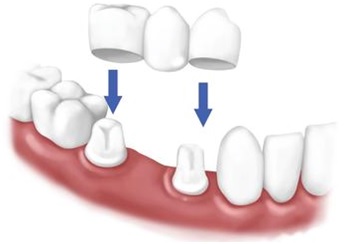 crowns bridges dental