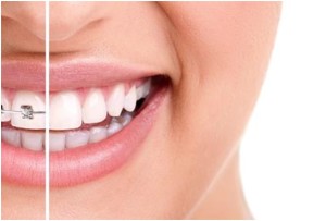 Invisalign for adults and teens in Falls Church