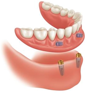 implants full lower denture in Virginia