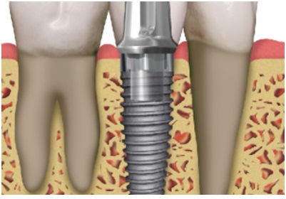 tooth implant root abutment