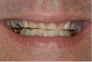 bite problems northern Virginia Prosthodontist