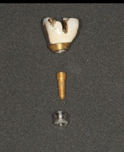broken implant northern virginia prosthodontist