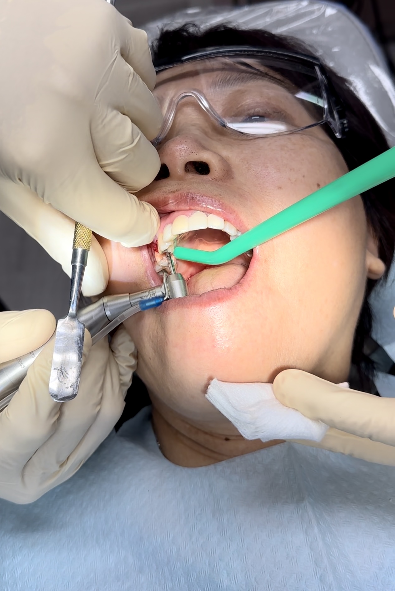 an image showing how a dental implant procedure is done in Falls Church, VA